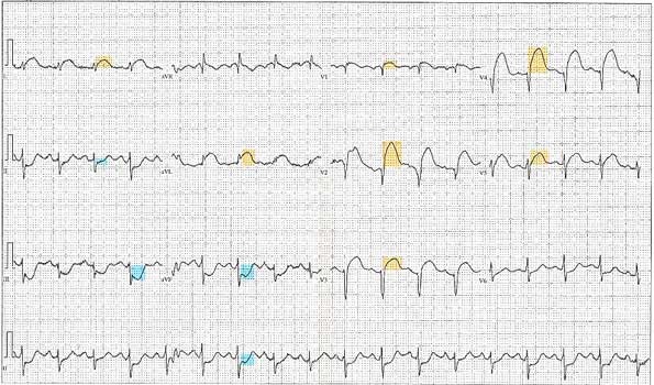 12_Lead_EKG_ST_Elevation_