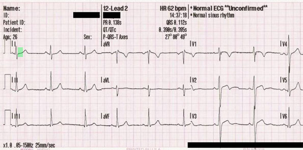 NormalECG-greenST