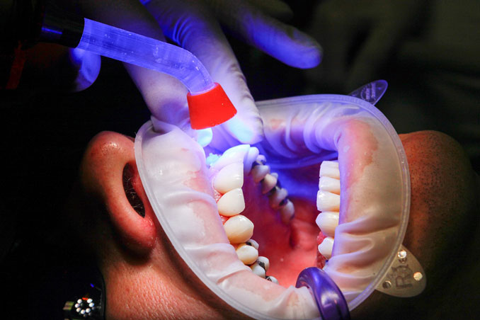 Dentist curing lights (PHOTO CREDIT: <a href=https://www.arlingtoncardinal.com/2021/08/innovations-that-show-were-living-in-the-future/