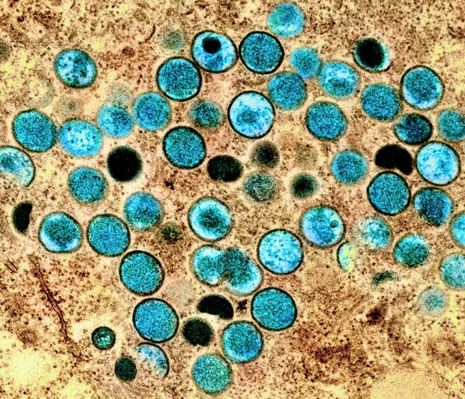 Colorized transmission electron micrograph of monkeypox particles (teal) found within an infected cell (brown), cultured in the laboratory. Image captured and color-enhanced at the NIAID Integrated Research Facility (IRF) in Fort Detrick, Maryland. Credit: NIAID (National Institute of Allergy and Infectious Diseases)